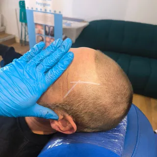 DE PANIQUE 🍀 il est normal qu'après votre séance de tricotpigmentation RELOADHAIR vous ayez quelque