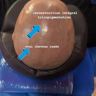 Retrouve confiance en toi grâce à la tricopigmentation capillaire qui te permettra de retrouver une 