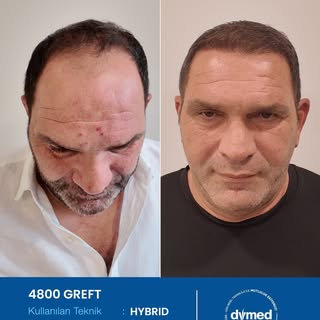 Her cerrahi veya girişimsel işlemde sonuçlar kişiden kişiye değişiklik gösterebilir. İşlem öncesinde