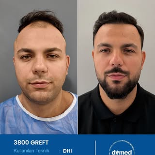 Her cerrahi veya girişimsel işlemde sonuçlar kişiden kişiye değişiklik gösterebilir. İşlem öncesinde