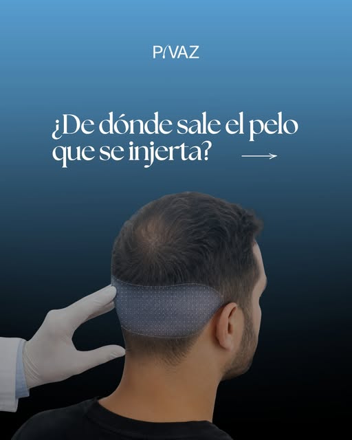 La clave del injerto capilar no empieza donde falta pelo. Empieza en la zona donante. 

En Clínica P