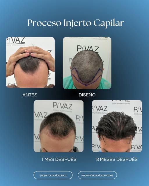 8 meses después, las entradas cuentan otra historia. 

Tras el injerto capilar, la zona frontal ha i