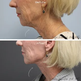 Neck Lift Procedure 

This patient didn't like the appearance of her neck. We offered to help!

#nec