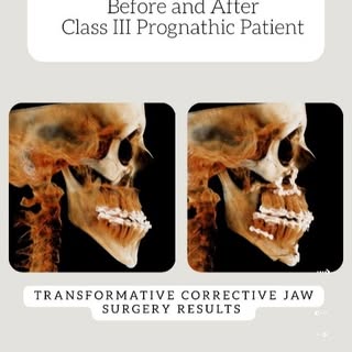 Favorite surgery?
Orthognathic jaw surgery of course!
 
This patient underwent the following procedu