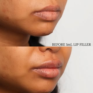 Just one syringe of filler! 
#lipfillerbeforeandafter #lipfiller #1mLmagic #cosmetic #omfs