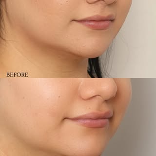 One syringe of chin filler makes such a difference! 

#omf #cosmetics #filler #chinfiller