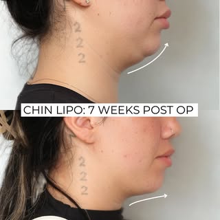 Chin Lipo removes stubborn fat to create a  sharper jawline and more balanced profile.  Early 7 week