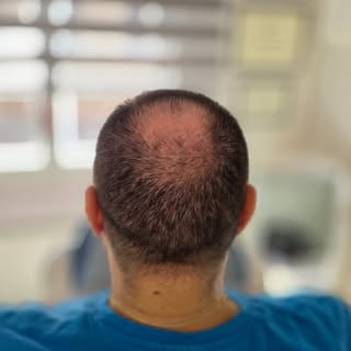 🔍 Capelli diradati?
La tricopigmentazione effetto densità è la soluzione ideale per chi desidera un