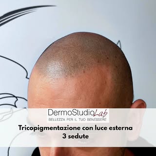 Tricopigmentazione a luce naturale
Quando il risultato è fatto bene… si vede anche senza filtri.

In