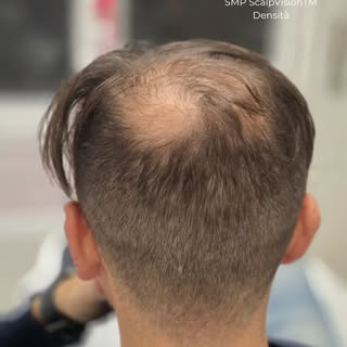 TRICOPIGMENTAZIONE DENSITÀ

Diradamento evidente?
La SMP ScalpVision™ Densità riempie otticamente le