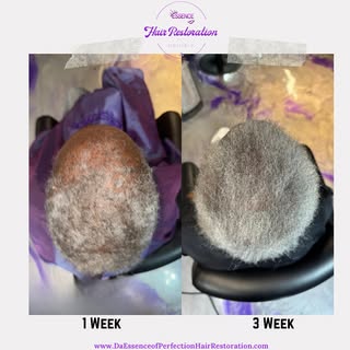 Hair Restoration at its Finest…. 

Here we have our client who has been receiving our Hair Restorati