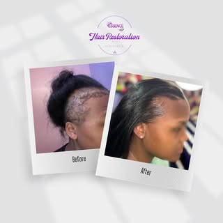 This proves that all Hair Loss isn’t Permanent! 

After my client gave birth to her son 4 years ago,