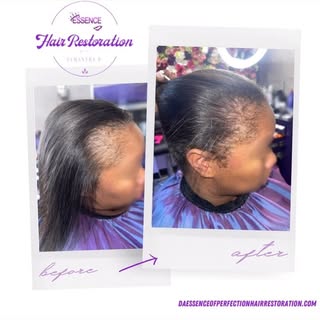 After having a child, my clients hair began falling out on her edges due to telogen effluvium, which