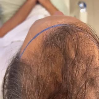 Transplante capilar # tricologia # Mais um ex calvo# Restaurando confiança e auto estima