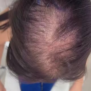 Transplante capilar feminino ! Restaurando emoções e auto estima . #transplantecapilar #tricologia #