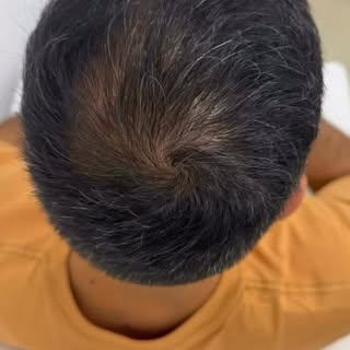 Resultado de 3 meses de tratamento capilar não cirúrgico , devolvendo fios e confiança!! 🥰🥰🥰