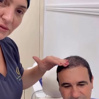 Transplante capilar 4 meses de procedimento em um paciente que era grau 7 . Agora é só felicidade !!