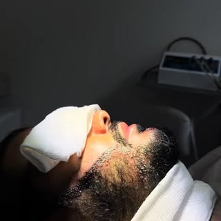Transplante de barba ! Redefindo e corrigindo falhas . Auto estima renovada !!! #transplantecapilar 