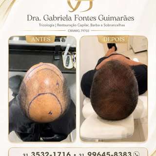 1 ano de evolução após o transplante capilar.

Um resultado que mostra como o crescimento acontece c