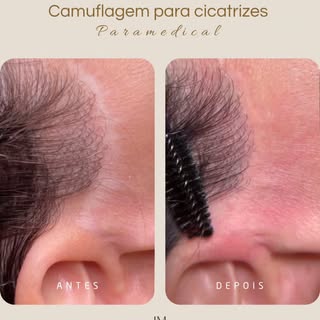 Camuflagem para Cicatrizes 
Clínica especializada em cuidados com a pele e Camuflagem estética.

Con