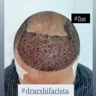 Love is in the hair ! 💖
#hairrestoration #hairtransformation #hair #hairtransformation #hairgoals #