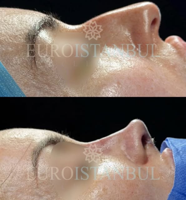👃 Rinoplastica in Turchia con Euro Istanbul 🇹🇷

Un percorso completo e organizzato, dalla valutaz