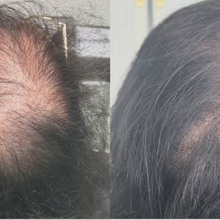 Hoy os mostramos el cambio de una encantadora paciente!!! Impresionante, verdad?? ❤️❤️❤️ #implatecap