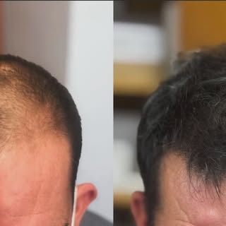 ¿Qué os parece? Es el antes y después de un implante capilar. Da gusto ver a nuestros pacientes!  #i
