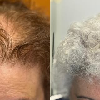 Y qué me decís de esta paciente? Menudo cambio, verdad? ❤️ #alopeciaandrogenetica #mesoterapiacapila