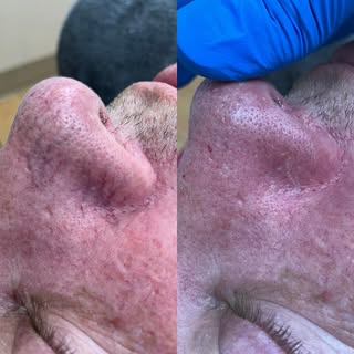 Spider vein or broken capillaries? We can treat them. Free consultations. Call or text.
#spidervein 