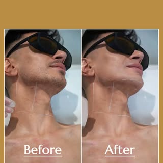 Clean neckline. Less shaving. More confidence. 

Tired of constantly shaving or dealing with irritat
