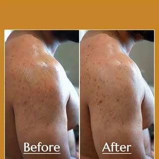 Tired of constantly shaving your shoulders? 

Men’s Shoulder Laser Hair Removal offers a smarter way