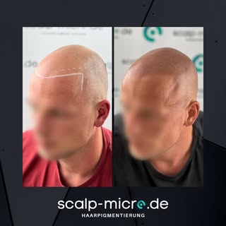 • Softes und natürliches Ergebnis nach ❸ Sitzungen • Lass´ dich kostenlos, vertraulich und unverbind