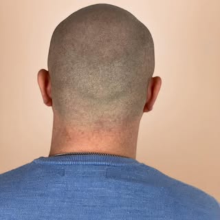 • Eine Tonsur lässt dich älter aussehen, als du wirklich bist • Die Haarpigmentierung eignet sich he
