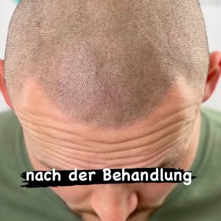 • Haarpigmentierung bei Geheimratsecken nach HT•
#smp #haarpigmentierung #haartransplantation #hairt