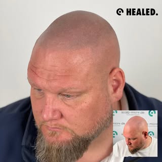 • Abgeheiltes Ergebnis nach ❸ Sitzungen • Natürliche und softe Haarlinie 💯👌🏼 
• kostenlose Beratu