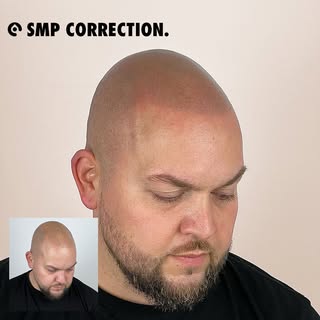 • "Hot-Fix" einer anderen SMP-Behandlung ⛑️! Bereits nach der 1. Korrektur-Sitzung, sieht man einen 