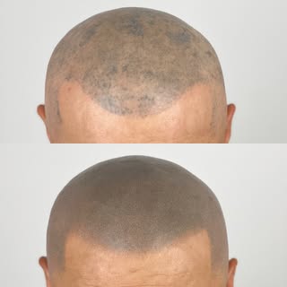 Korrektur einer Haarpigmentierung eines Anbieters, der sein Handwerk offensichtlich nicht versteht. 
