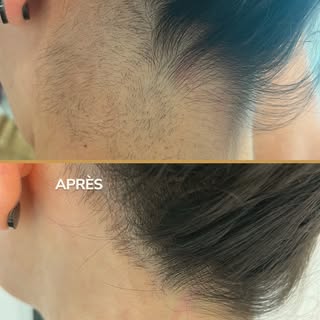 Avant / Après : une nuque plus nette, débarrassée de la pilosité indésirable ✨⁠
⁠
Cette patiente sou