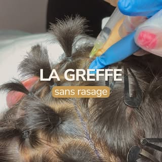 Et si vous gardiez vos cheveux le jour de votre greffe ? ✨⁠
⁠
👉 C'est ce que permet la Greffe FUE s