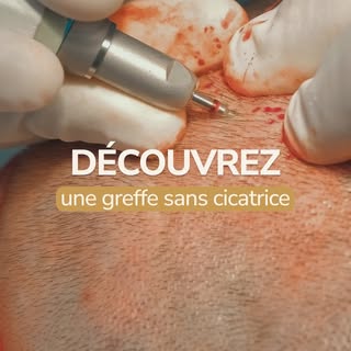 Greffe FUE ou FUT : quelle différence ? 🔍⁠
⁠
2 techniques de greffe capillaire, 2 approches distinc