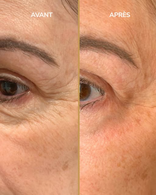 Avant / Après : raffermir le regard sans chirurgie 👁️⁠
⁠
Cette patiente présentait un léger relâche