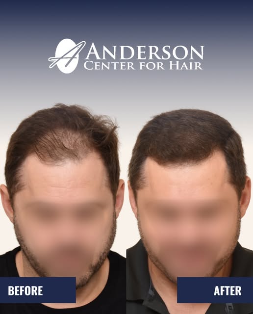 Careful hairline design and thoughtful placement can restore density while keeping the result natura