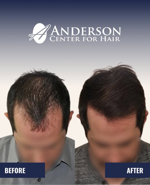 You don’t have to wait until you’re bald to address hair loss!

Thinning, increased scalp visibility