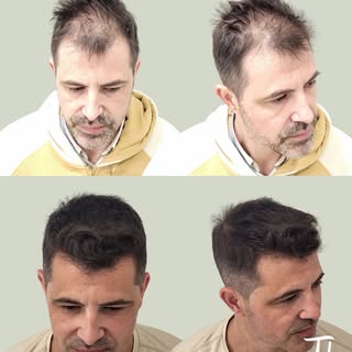 Hoy os muestro la evolución de este paciente 7 meses después de su injerto capilar. 💯

En este caso