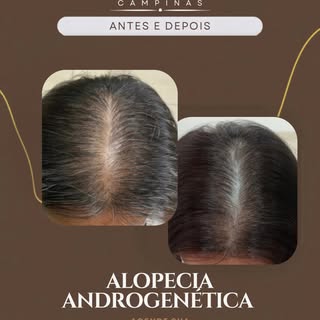 Neste caso, a paciente apresentava uma importante rarefação capilar causada pela alopecia androgenét