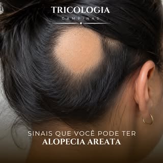 A Alopecia Areata é uma condição autoimune caracterizada pela queda de cabelo de forma súbita, geral