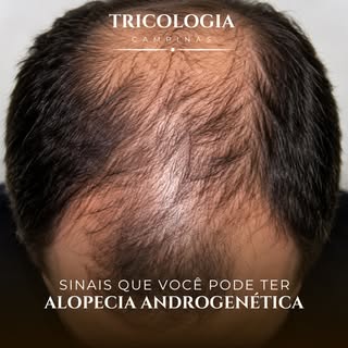 A alopecia androgenética costuma surgir de forma lenta e muitas vezes passa despercebida no início. 