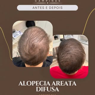 Este cliente chegou até nós apresentando um quadro de queda capilar compatível com Alopecia Areata D
