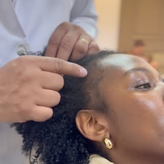 Neste caso, estamos tratando uma alopecia por tração. Nesta sessão, realizamos o microagulhamento ca